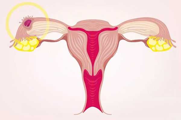 50天怀孕香港验血准吗,子宫肌瘤会影响到试管婴儿成功率嘛?