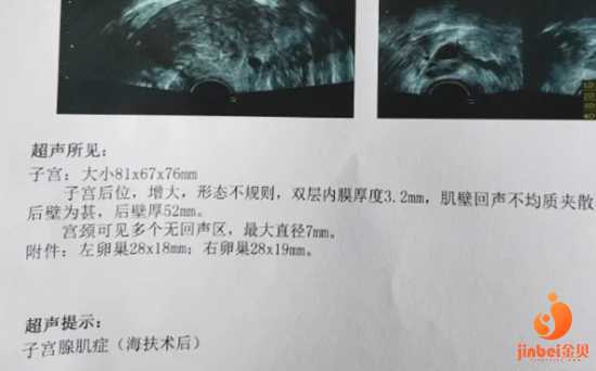 香港尹镇伟验血微信,子宫腺肌症痛经十年,走上试管之路