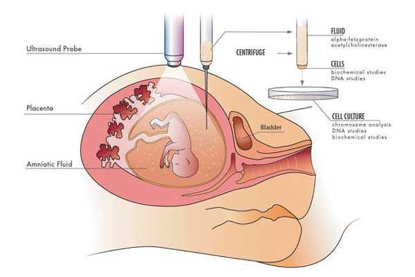 香港验血查dna费用,宫腔积液如何影响辅助生殖技术中助孕过程？