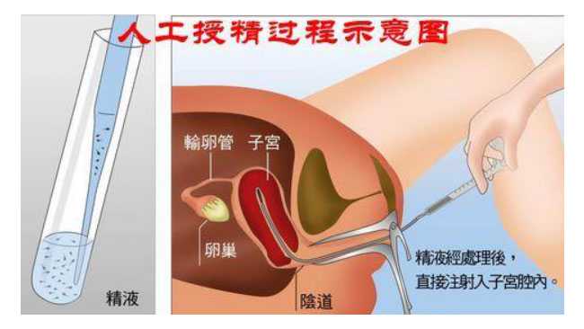 朋友圈发香港验血犯法,人工授精费用多少，授精是通过非自然方式将精液注入