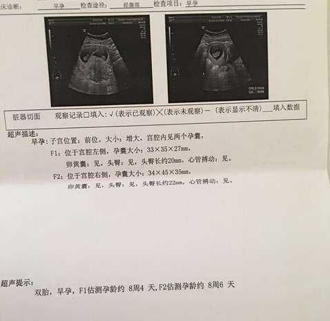 孕妇香港验血报告看男女吗,试管双胎如何预防早产
